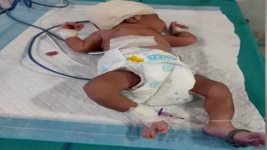 New born baby's head hurt during cesarean operation in Dinhata Hospital