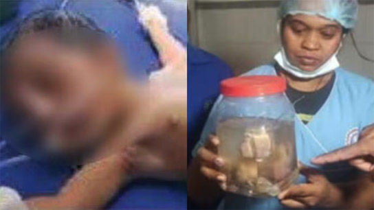 A newborn was found to have another baby developing inside his abdomen in Karnataka